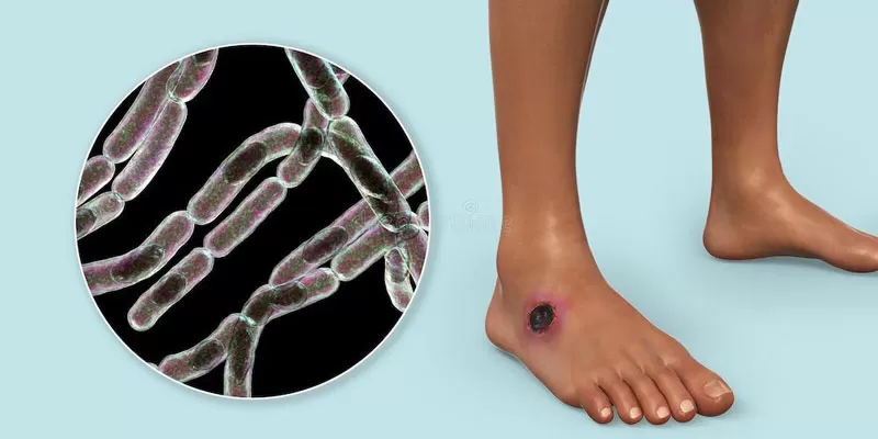 Thái Lan ghi nhận ca tử vong đầu tiên do bệnh than sau ba thập kỷ